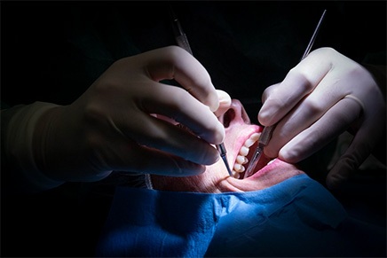 Implantologia dentale a carico immediato a Piove di Sacco