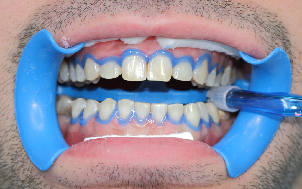 Pulizia dei denti e sbiancamento